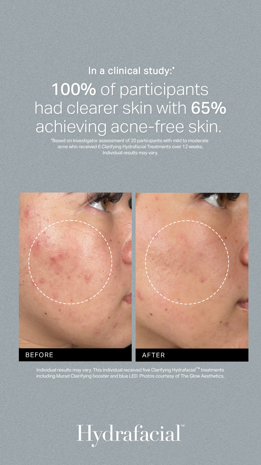 HydraFacial Deluxe with Booster - before and after results